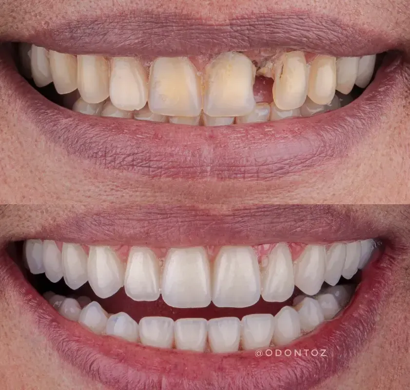 Aparelho autoligado ortodôntico de baixo atrito