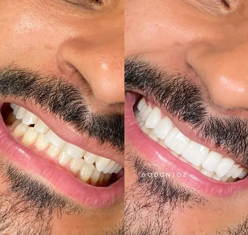 Aparelho estético de cerâmica ou safira nos dentes