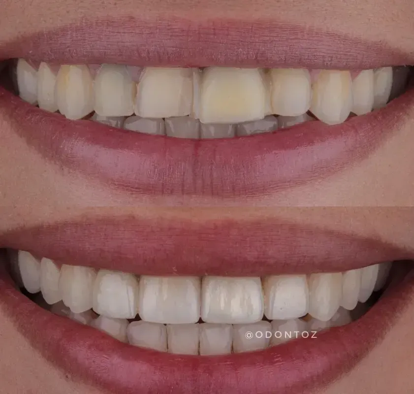 Aparelho lingual fixado na parte interna dos dentes