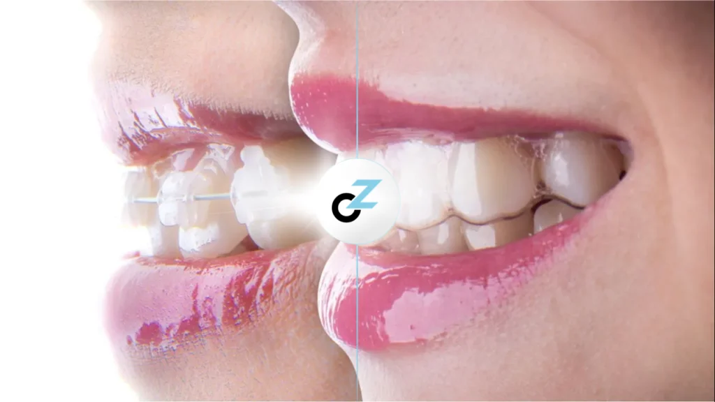 Aparelho Convencional ou Alinhador Transparente: qual é mais confortável?