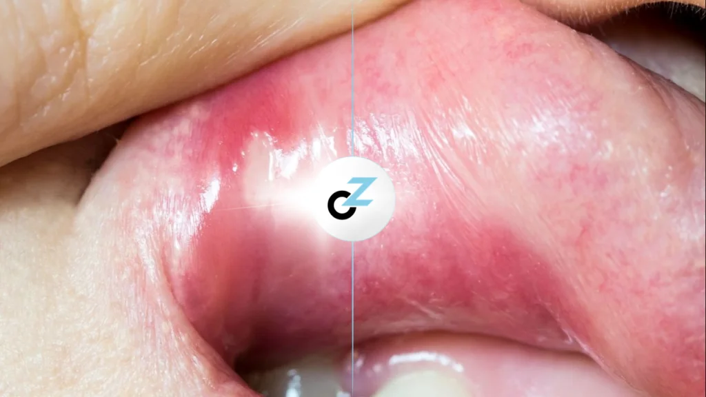 Afta na Boca: Causas, Sintomas e Como Tratar