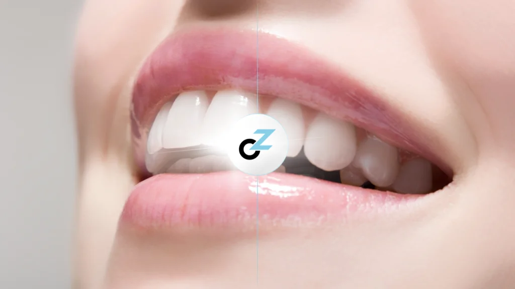 Qual Clareamento Dentário Escolher? Veja os Tipos