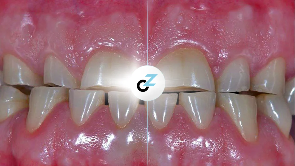 O Que é Bruxismo? Causas, Sintomas e Tratamentos