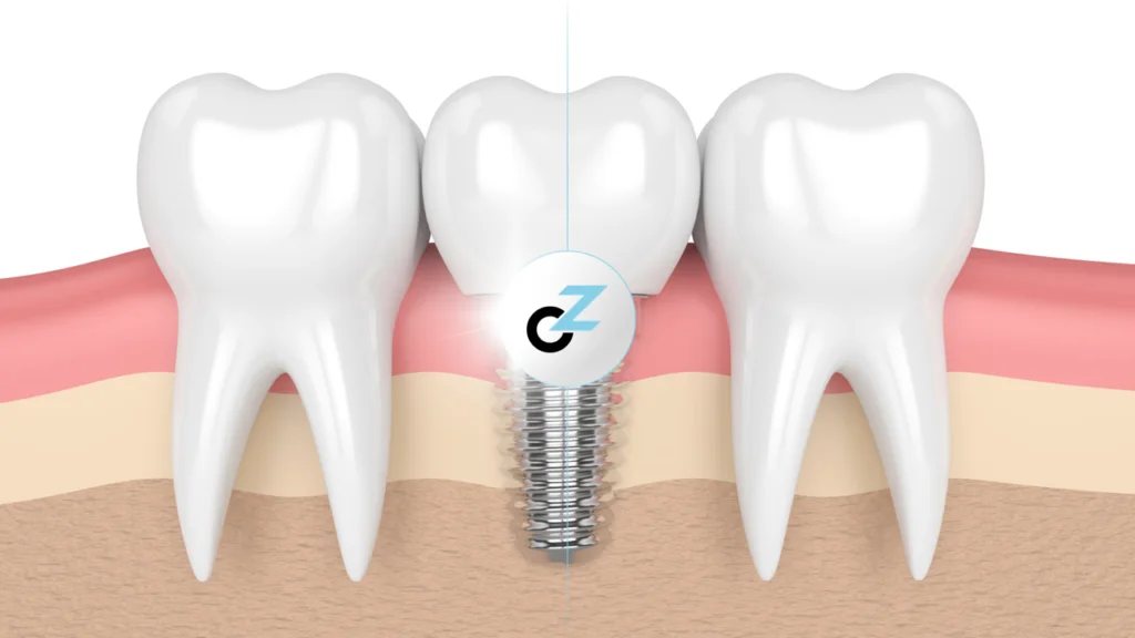 Implantodontia: O Que É e Como Funciona a Especialidade