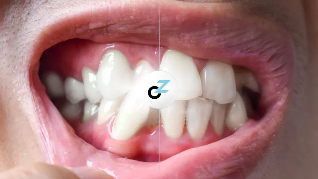 Dentes Desalinhados: Problemas, Riscos e Tratamentos