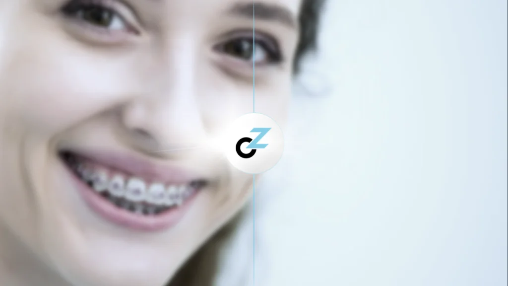 Aparelho Ortodôntico Convencional: Quanto Custa?