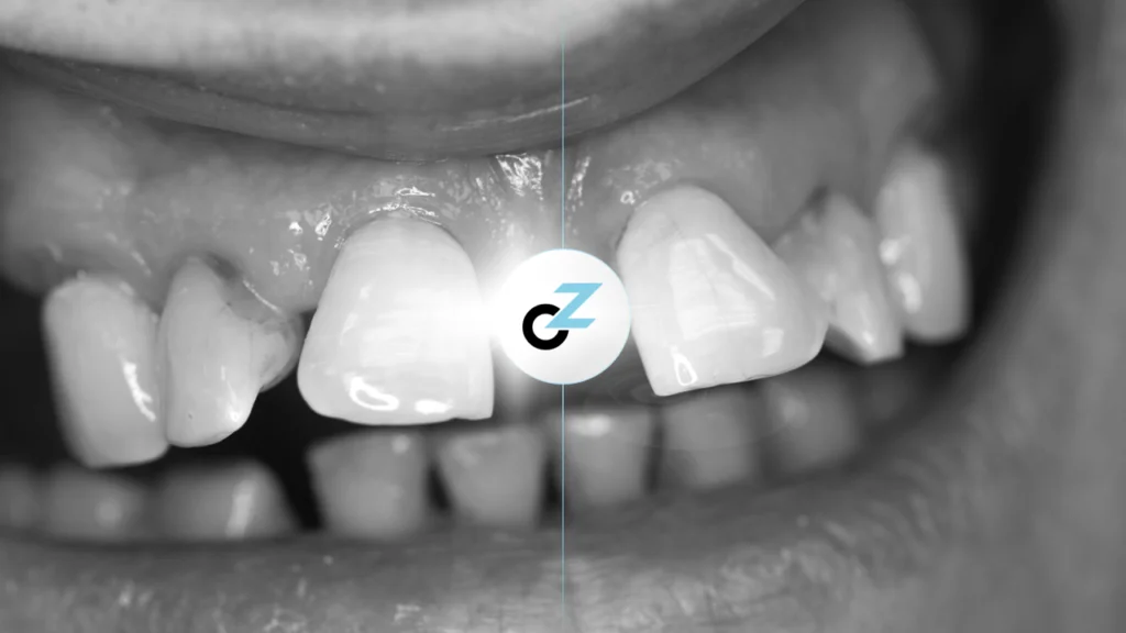 Dente Quebrado: o que fazer e para onde ir?