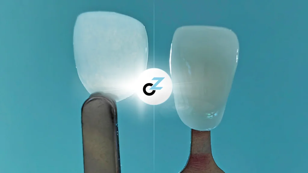 Desgaste de Lente de Porcelana: Como Funciona?