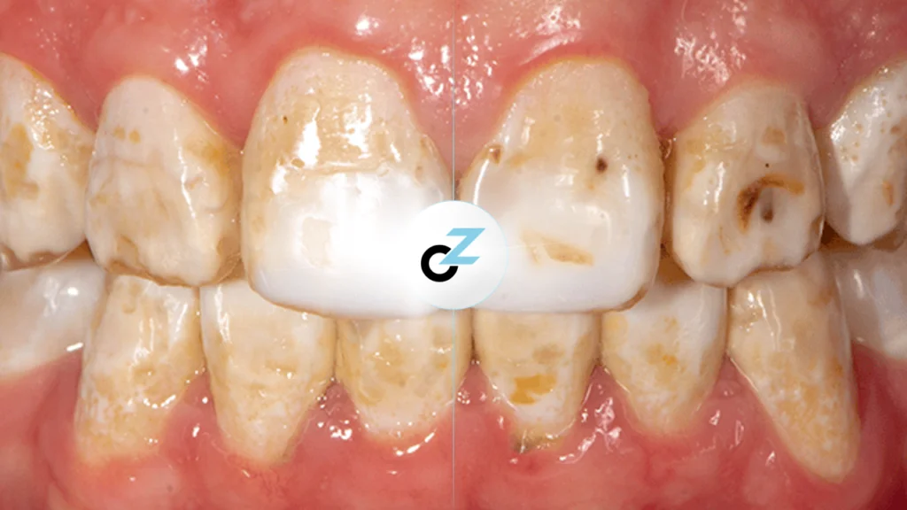 Fluorose Dentária: O Que É, Causas e Como Evitar