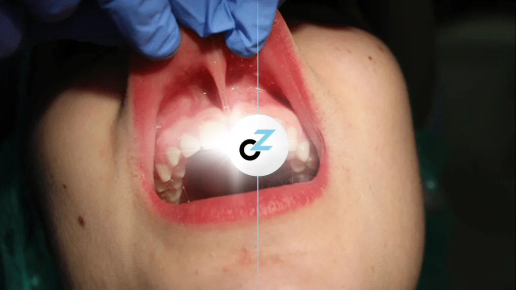 Frenectomia: Para Quem É Indicada e Como Funciona