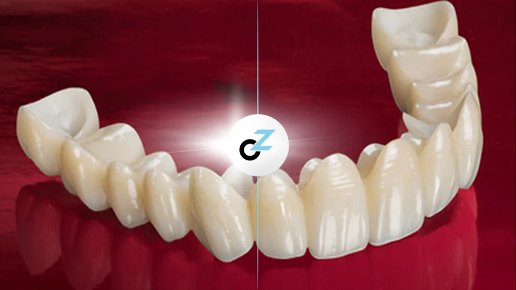 Melhor Tipo de Prótese Fixa: como escolher a ideal