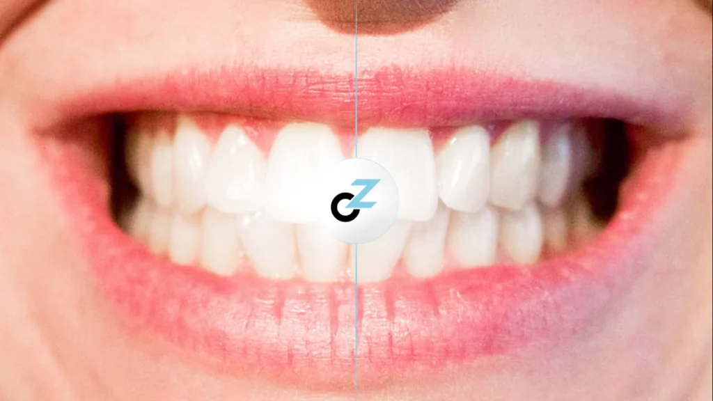 Tipos de Aparelhos Ortodônticos: conheça os 5 mais modernos