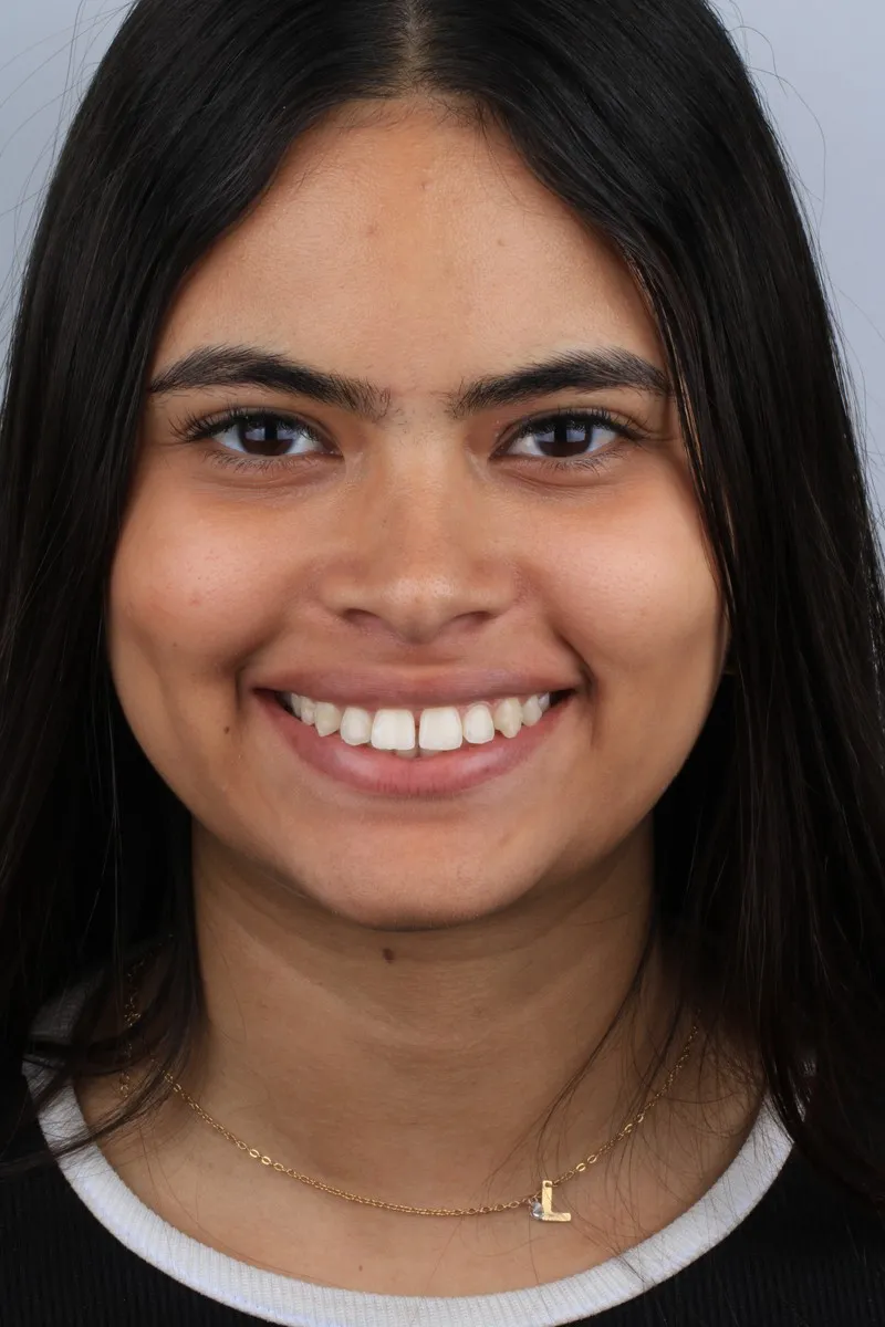 Rosto da Larissa antes do tratamento com alinhadores transparentes