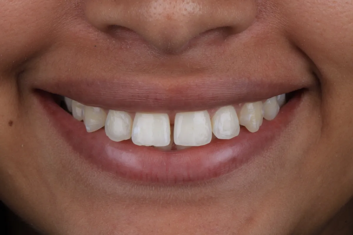 Antes do tratamento com aparelho invisível - OdontoZ