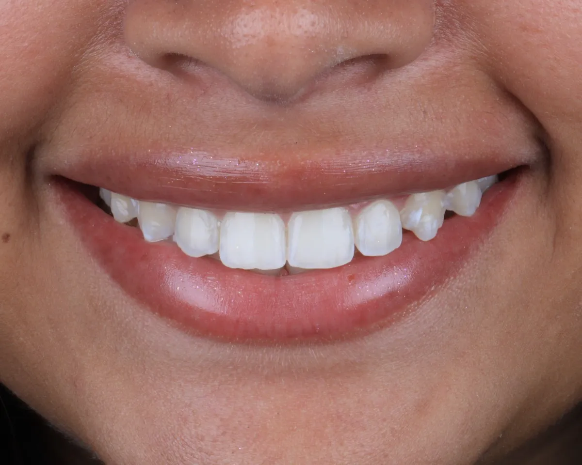 Depois do tratamento com aparelho invisível - OdontoZ