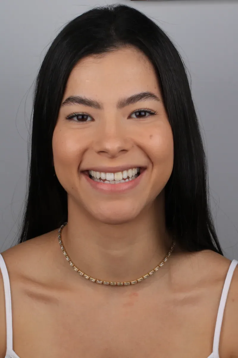 Rosto da Ruth antes do tratamento com lentes de contato dentais