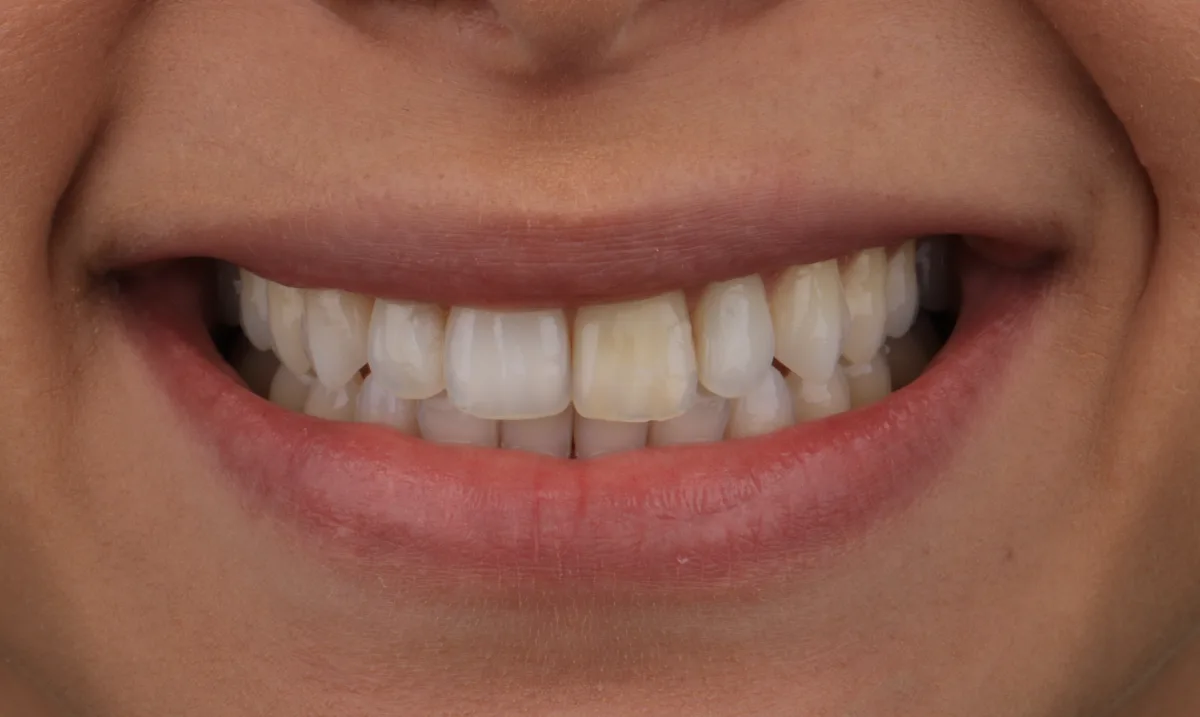 Sorriso da Ruth antes das lentes de contato dentais