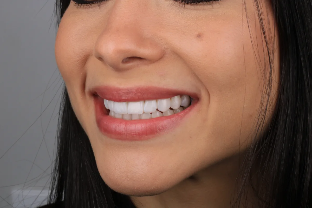 Sorriso da Ruth após lentes de contato dentais - vista lateral esquerda