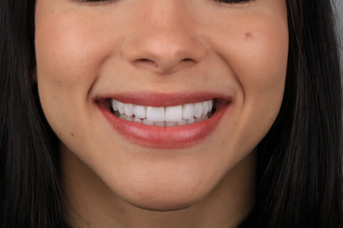 Sorriso da Ruth após lentes de contato dentais - vista frontal