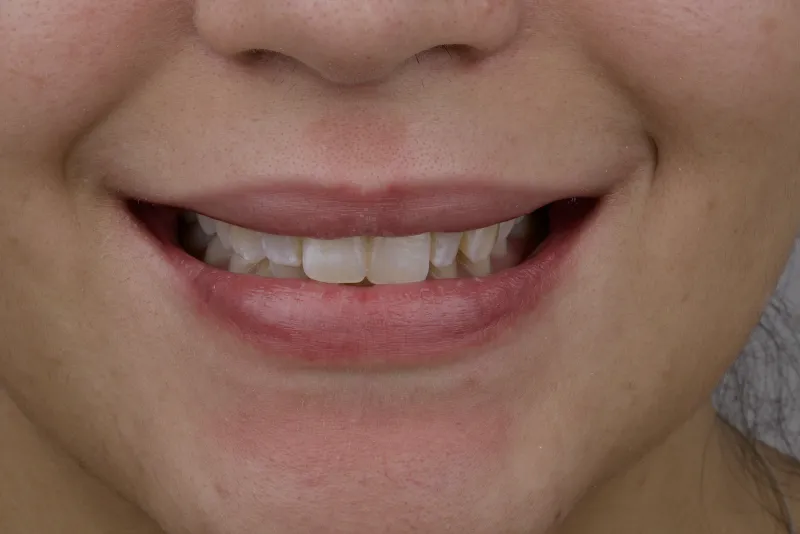 Sorriso antes das facetas de porcelana - OdontoZ