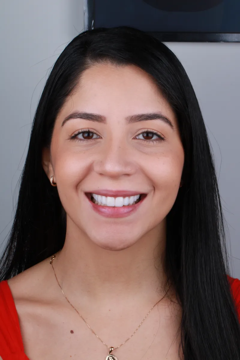 Rosto da Jéssica depois do tratamento com facetas de porcelana