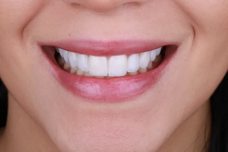 Sorriso depois das facetas de porcelana - OdontoZ