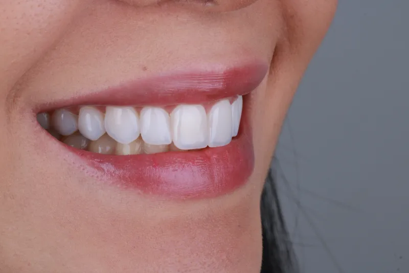 Sorriso da Jéssica após facetas - vista lateral direita