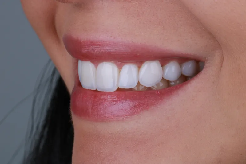 Sorriso da Jéssica após facetas - vista lateral esquerda