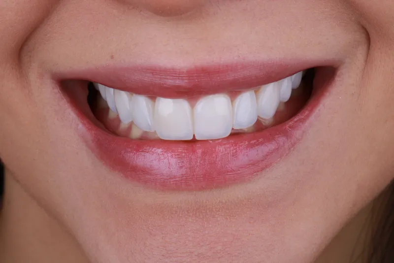 Sorriso da Jéssica após facetas - vista frontal